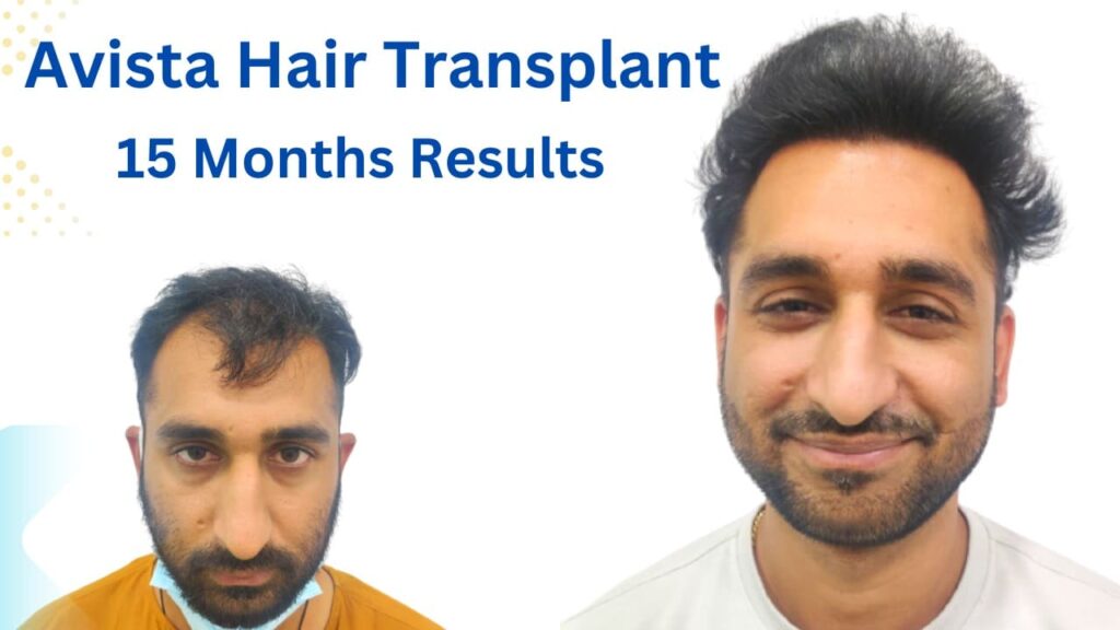hair transplant in india
