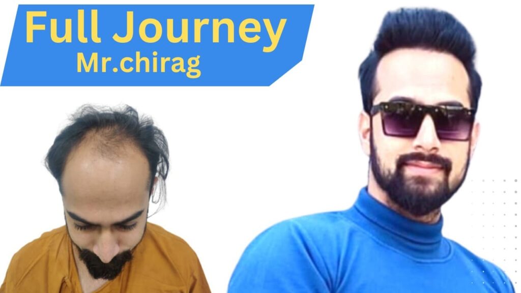 hair transplant in indore