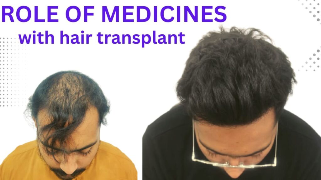 hair transplant in indore (12)